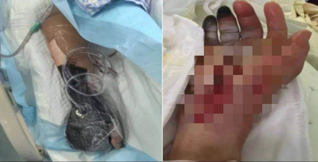皇冠会员如何申请
_戴手套！戴手套！死亡率近100%皇冠会员如何申请
，浙江已有人中招
